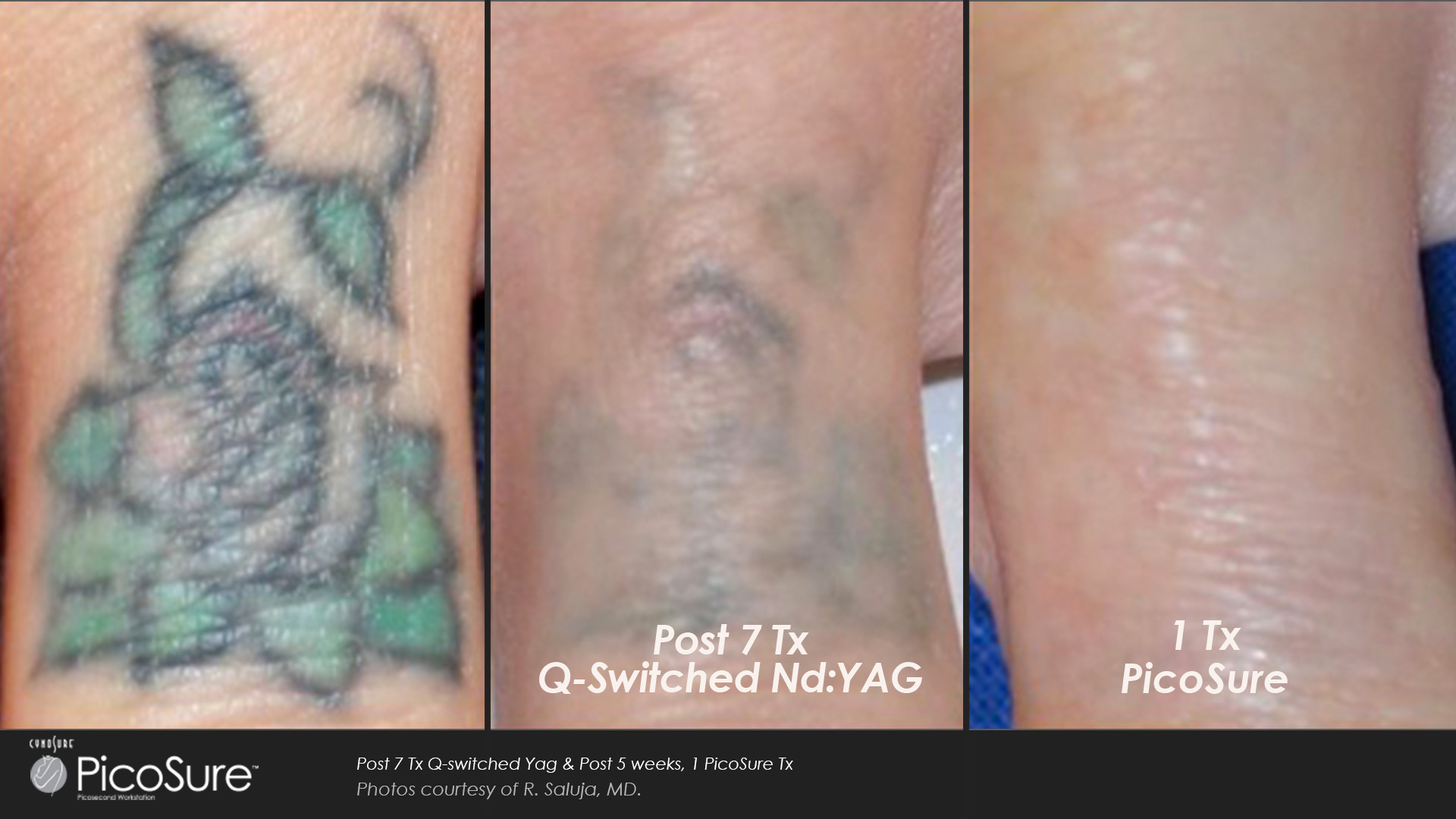 Picosure Tattoo Removal Healing Process