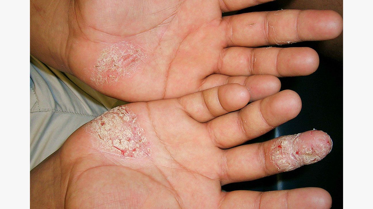 psoriasis on finger tips